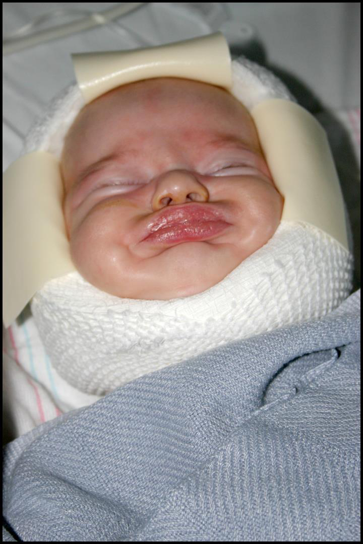 Photo of baby after surgery